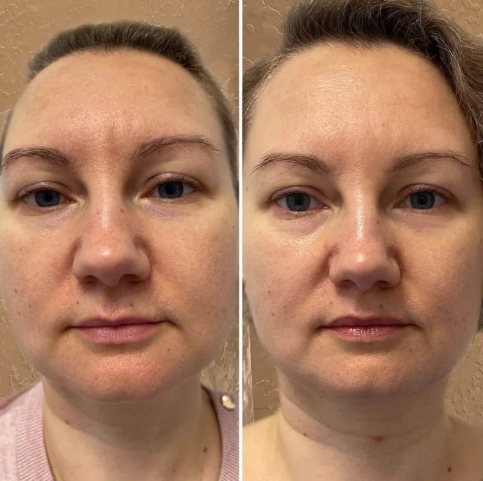 Скульптурно буккальный массаж лица в Москве