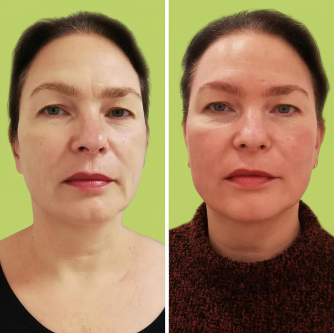 Скульптурно буккальный массаж лица в Москве