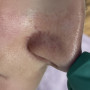 Удаление сосудистых звездочек на лице в Санкт-Петербурге